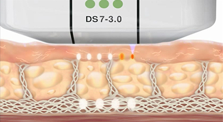 Ultherapy treatments - Intense Focused Ultrasound (IFUS)